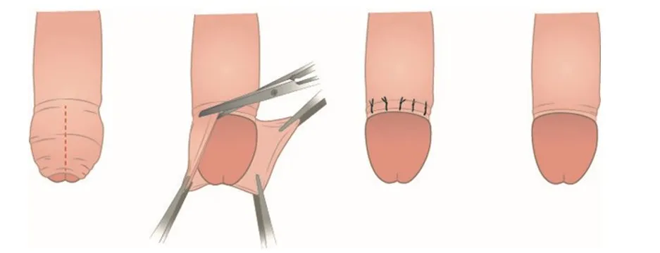 ablation prepuce chirurgie